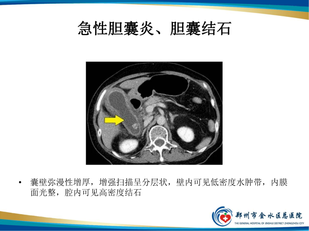 【PPT】胆囊癌的影像诊断-23