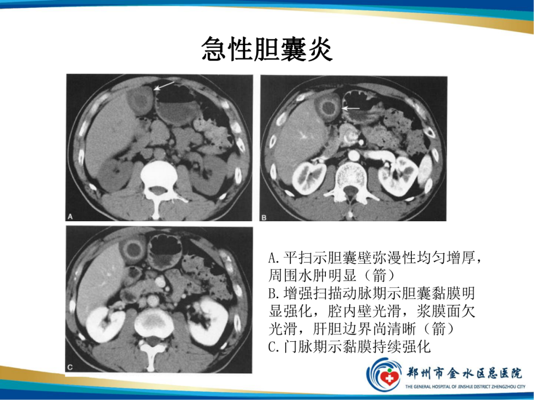 【PPT】胆囊癌的影像诊断-24