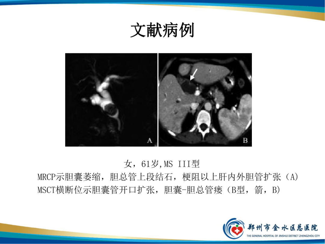 【PPT】胆囊癌的影像诊断-31