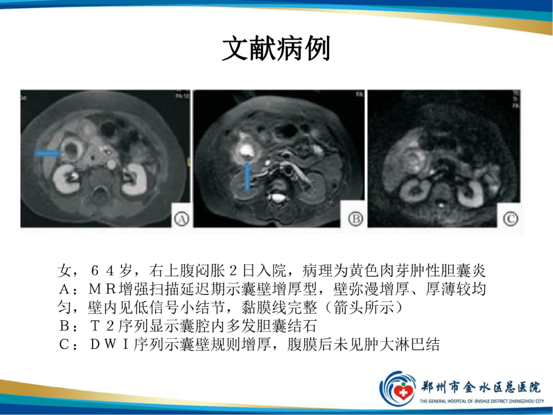 【PPT】胆囊癌的影像诊断-21