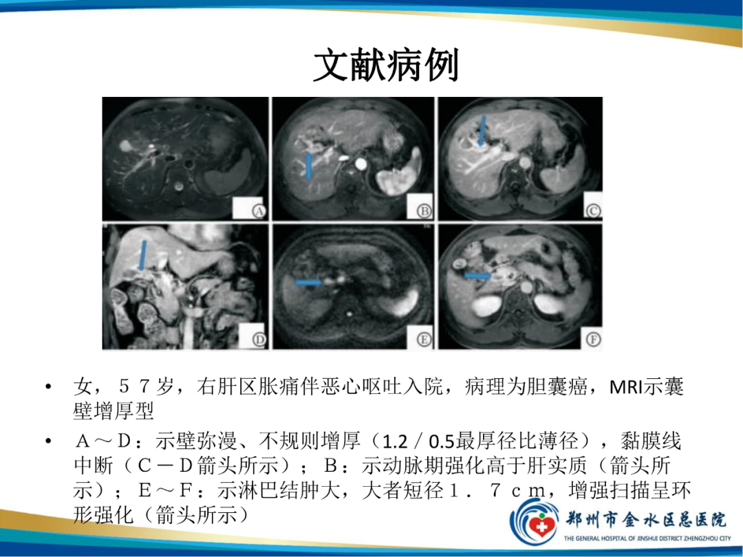【PPT】胆囊癌的影像诊断-16