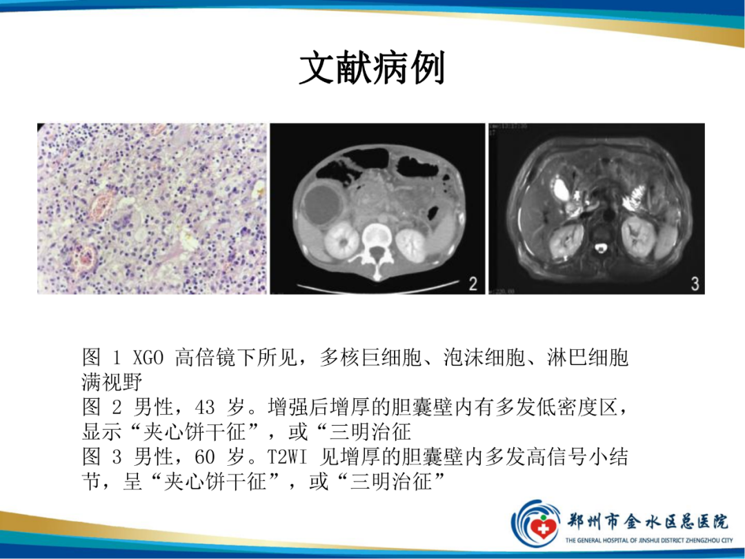 【PPT】胆囊癌的影像诊断-19