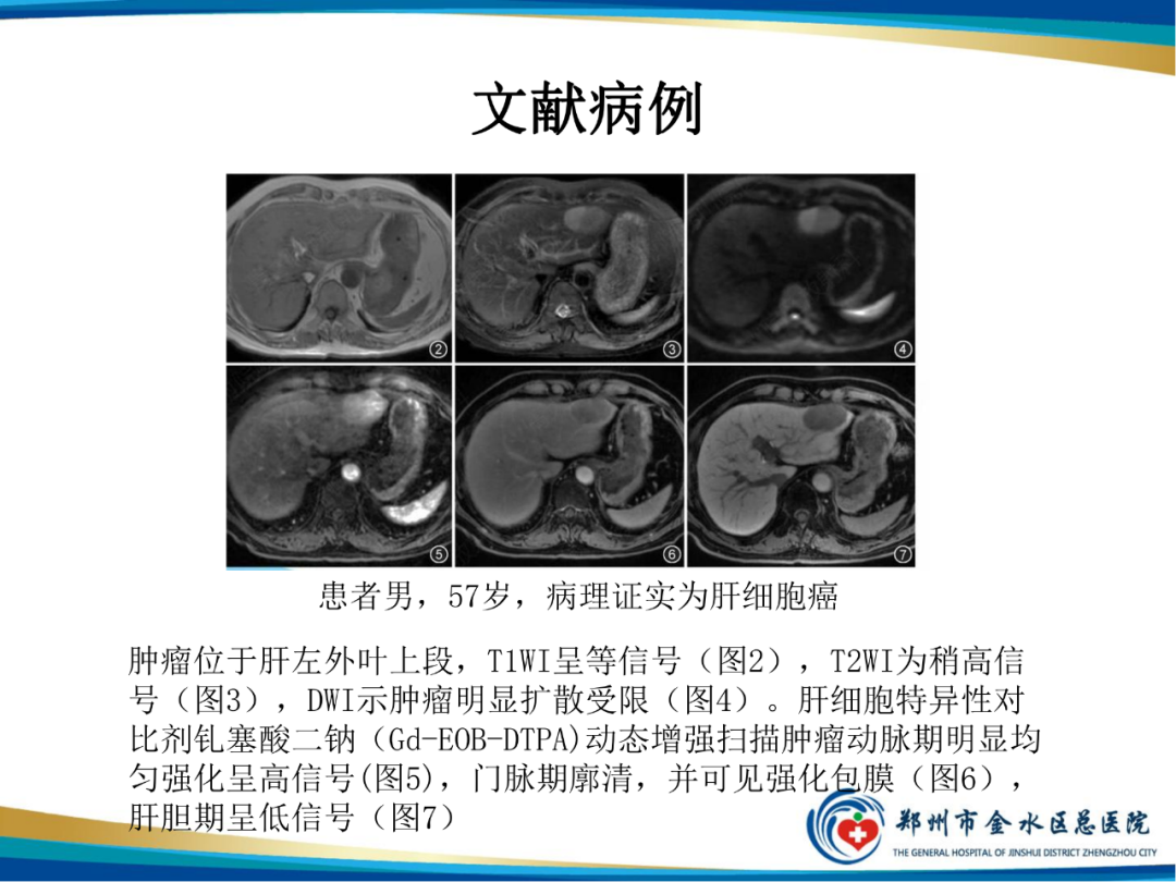 【PPT】胆囊癌的影像诊断-29