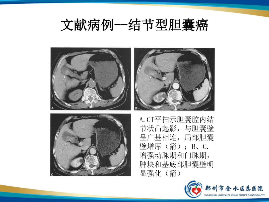 【PPT】胆囊癌的影像诊断-11