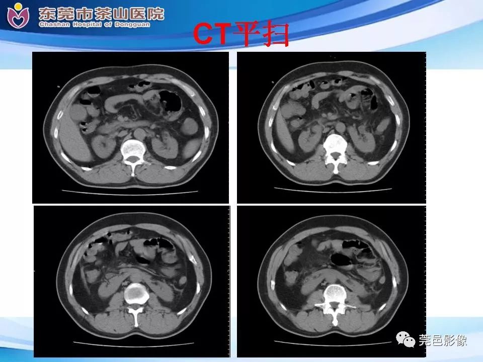 【PPT】腹茧症的影像诊断-10