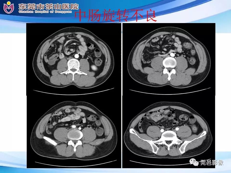 【PPT】腹茧症的影像诊断-56