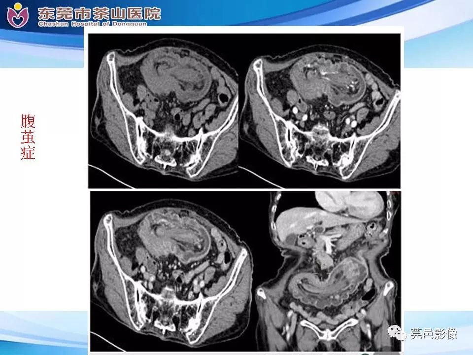 【PPT】腹茧症的影像诊断-35