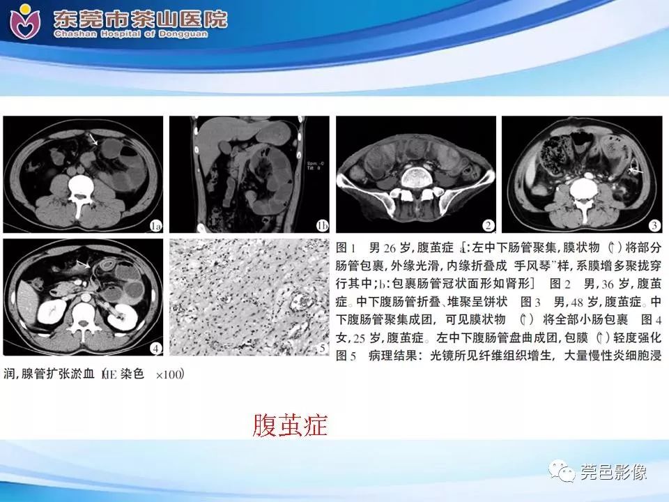 【PPT】腹茧症的影像诊断-40