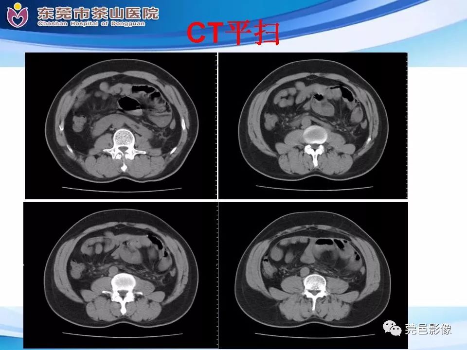 【PPT】腹茧症的影像诊断-11