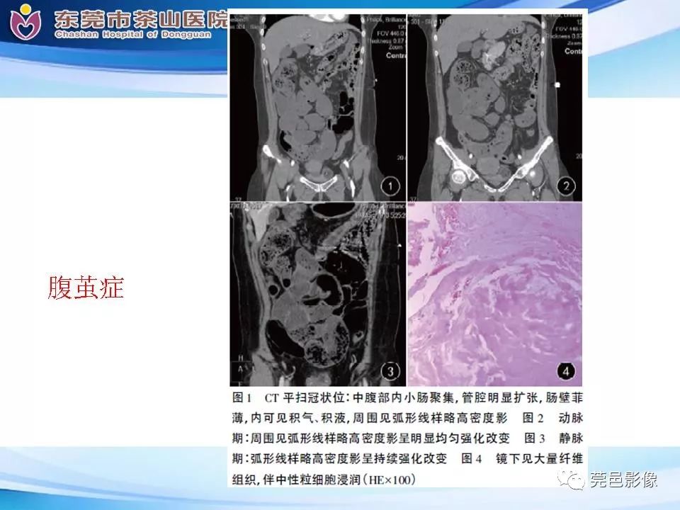 【PPT】腹茧症的影像诊断-38