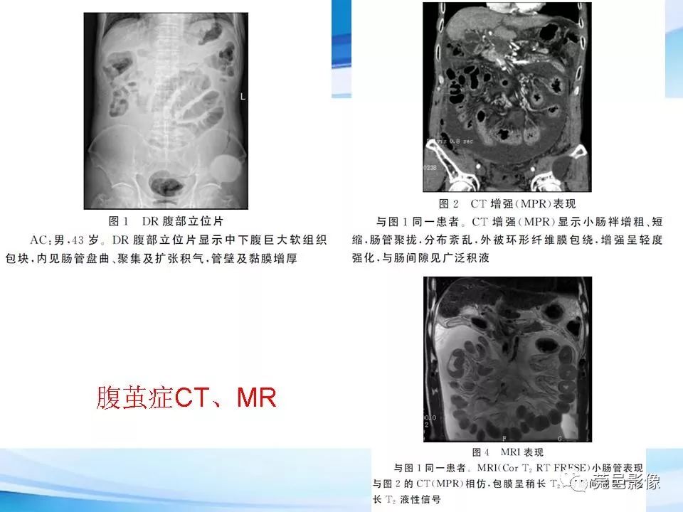 【PPT】腹茧症的影像诊断-42