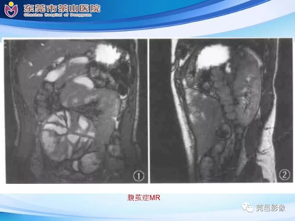 【PPT】腹茧症的影像诊断-43