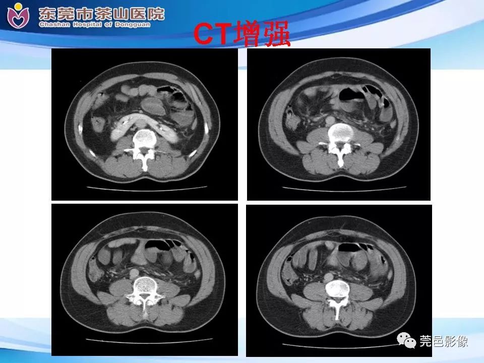 【PPT】腹茧症的影像诊断-15