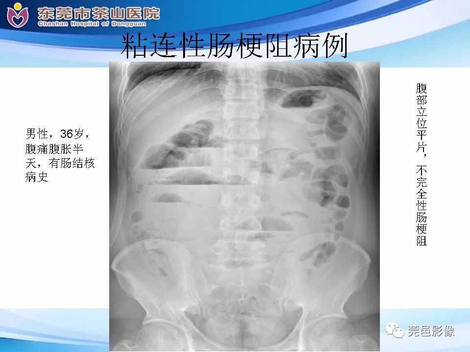 【PPT】腹茧症的影像诊断-49