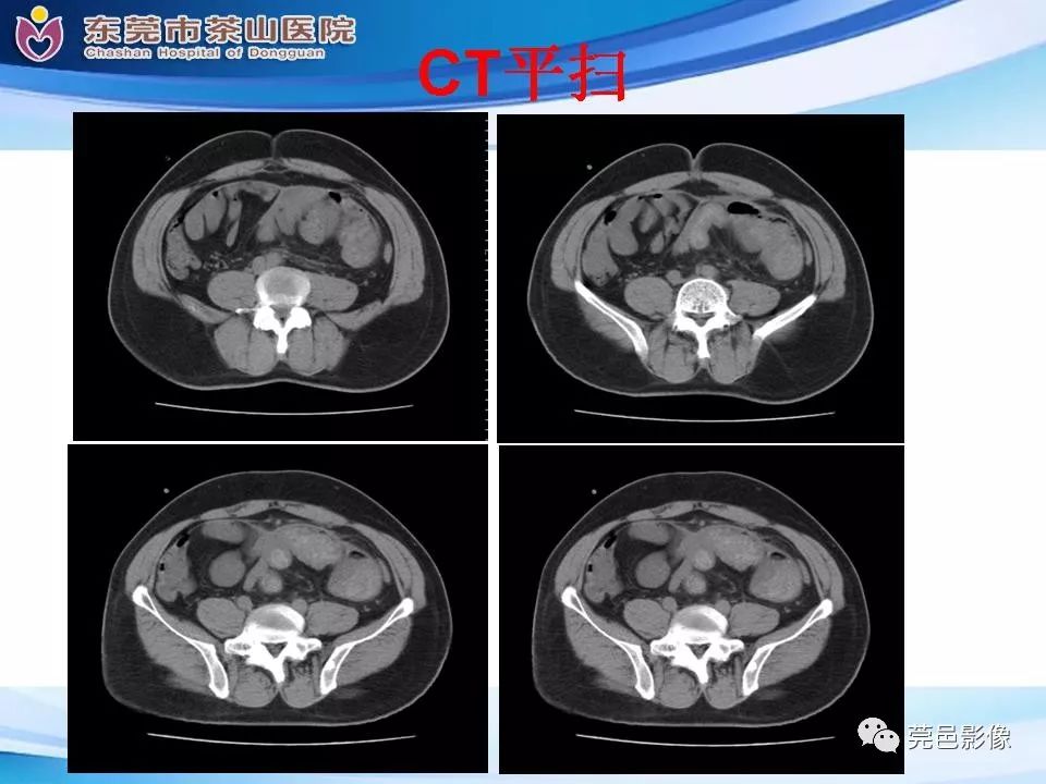 【PPT】腹茧症的影像诊断-12