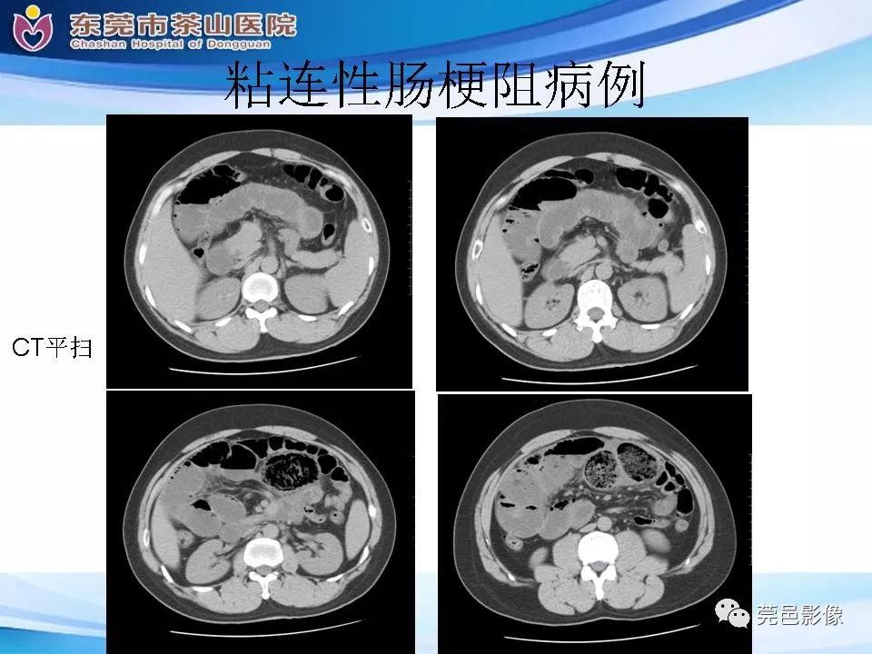 【PPT】腹茧症的影像诊断-50