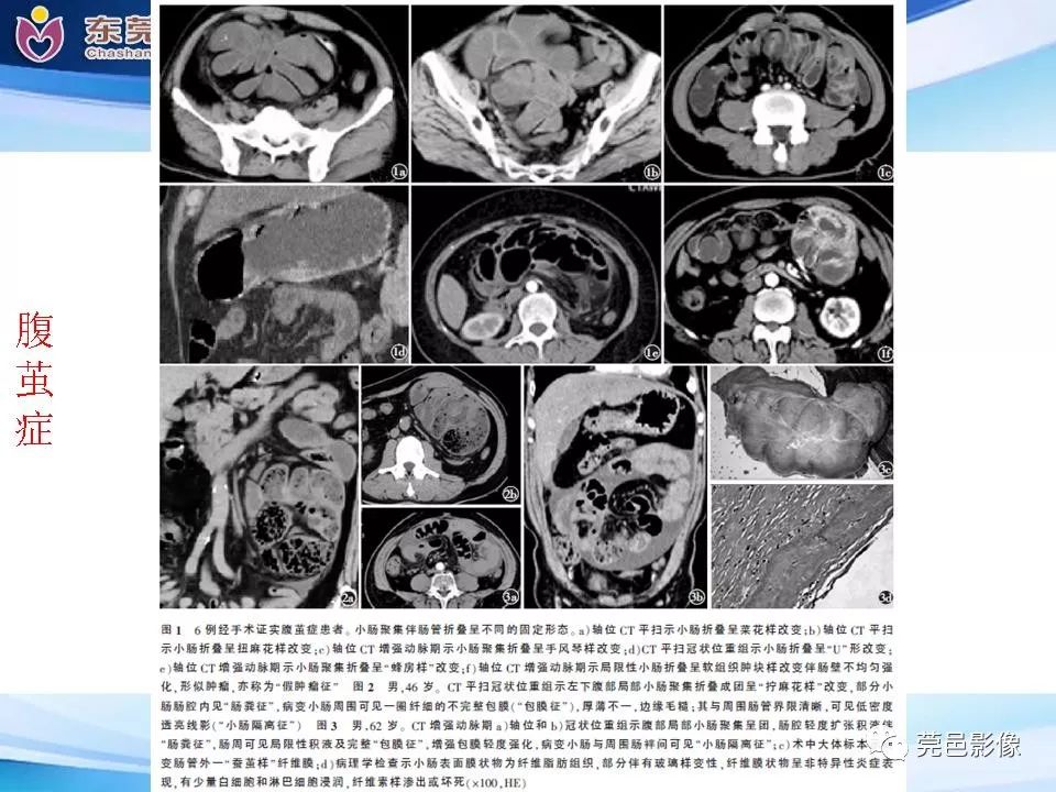 【PPT】腹茧症的影像诊断-39