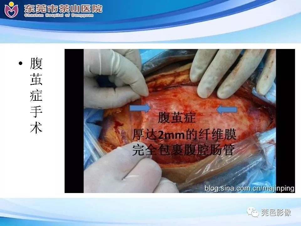 【PPT】腹茧症的影像诊断-45