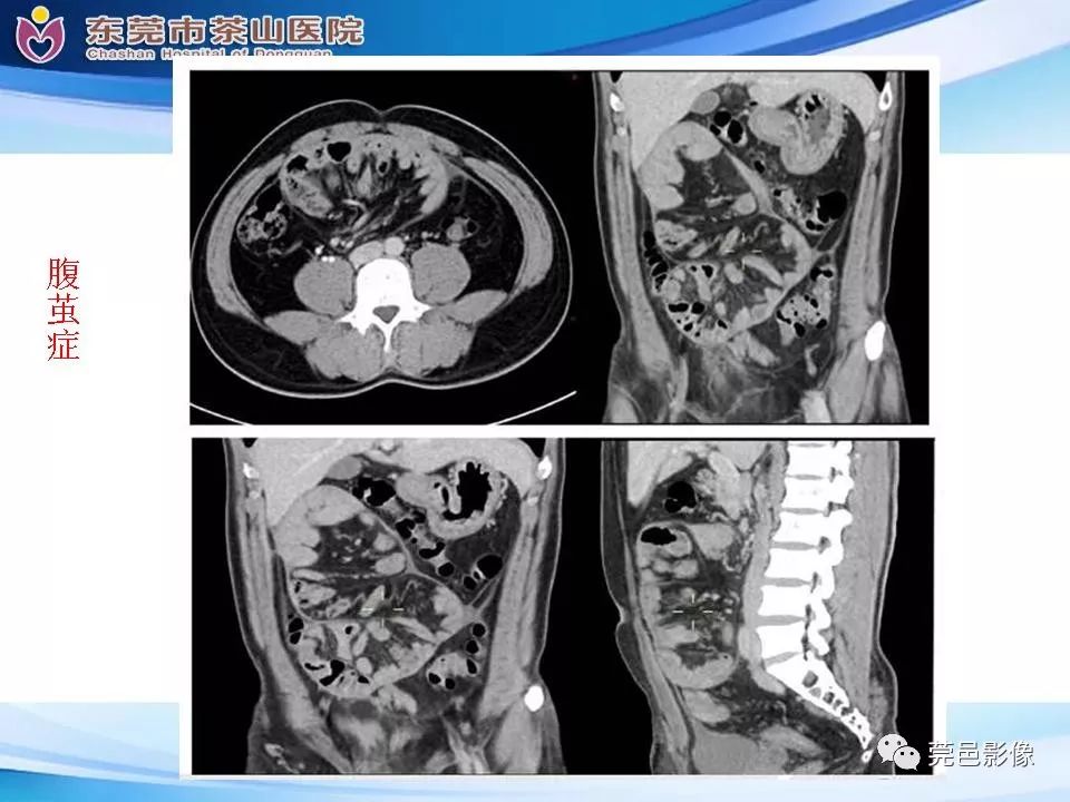 【PPT】腹茧症的影像诊断-33