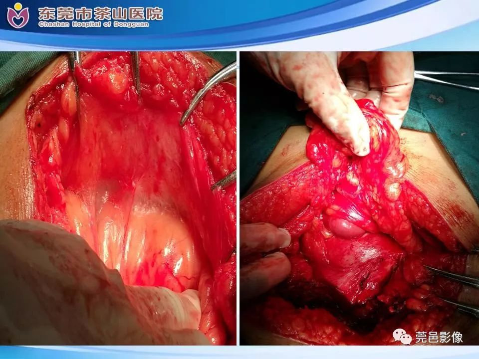 【PPT】腹茧症的影像诊断-20