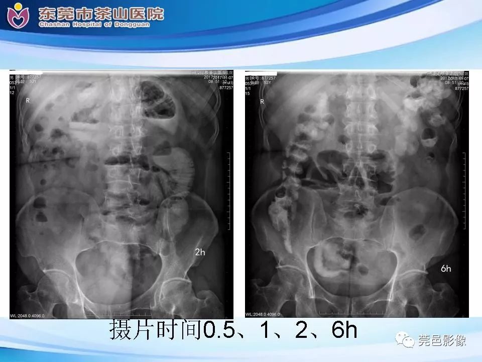 【PPT】腹茧症的影像诊断-8