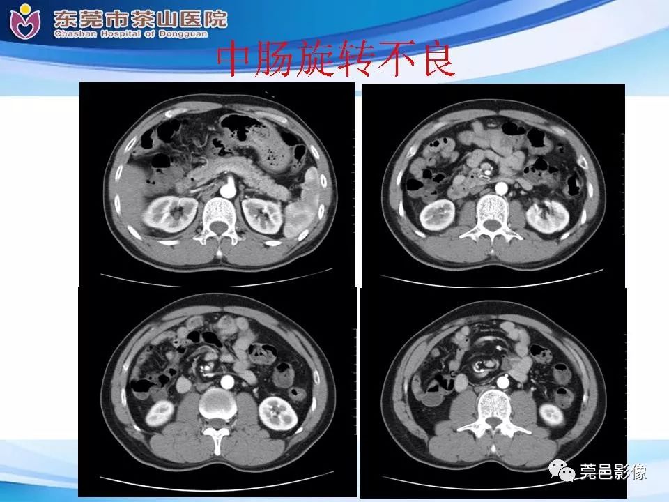 【PPT】腹茧症的影像诊断-55