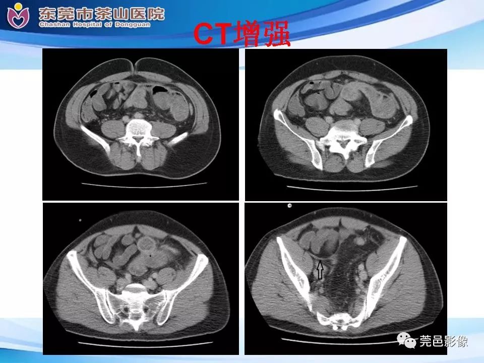 【PPT】腹茧症的影像诊断-16