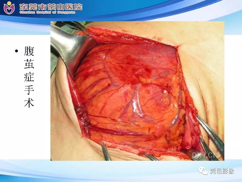 【PPT】腹茧症的影像诊断-46