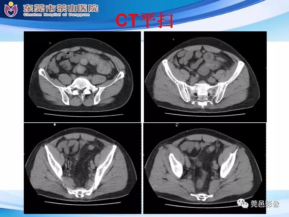 【PPT】腹茧症的影像诊断-13