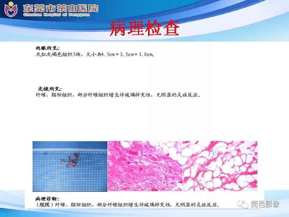 【PPT】腹茧症的影像诊断-21