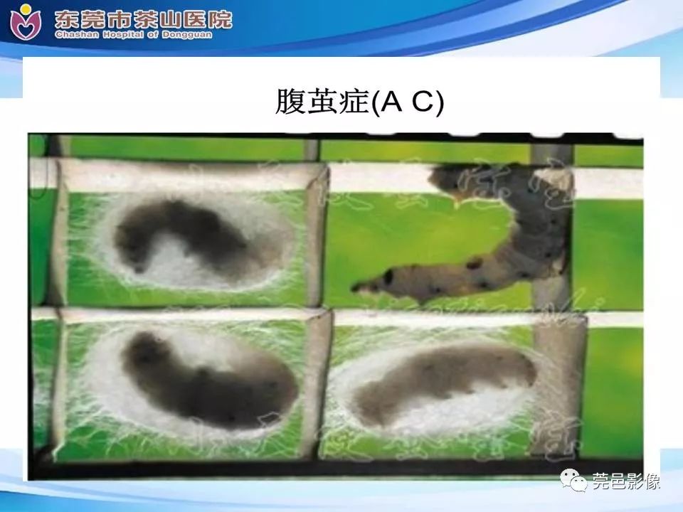 【PPT】腹茧症的影像诊断-23