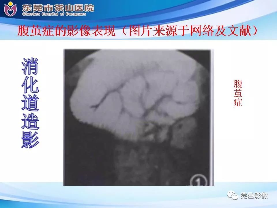 【PPT】腹茧症的影像诊断-31