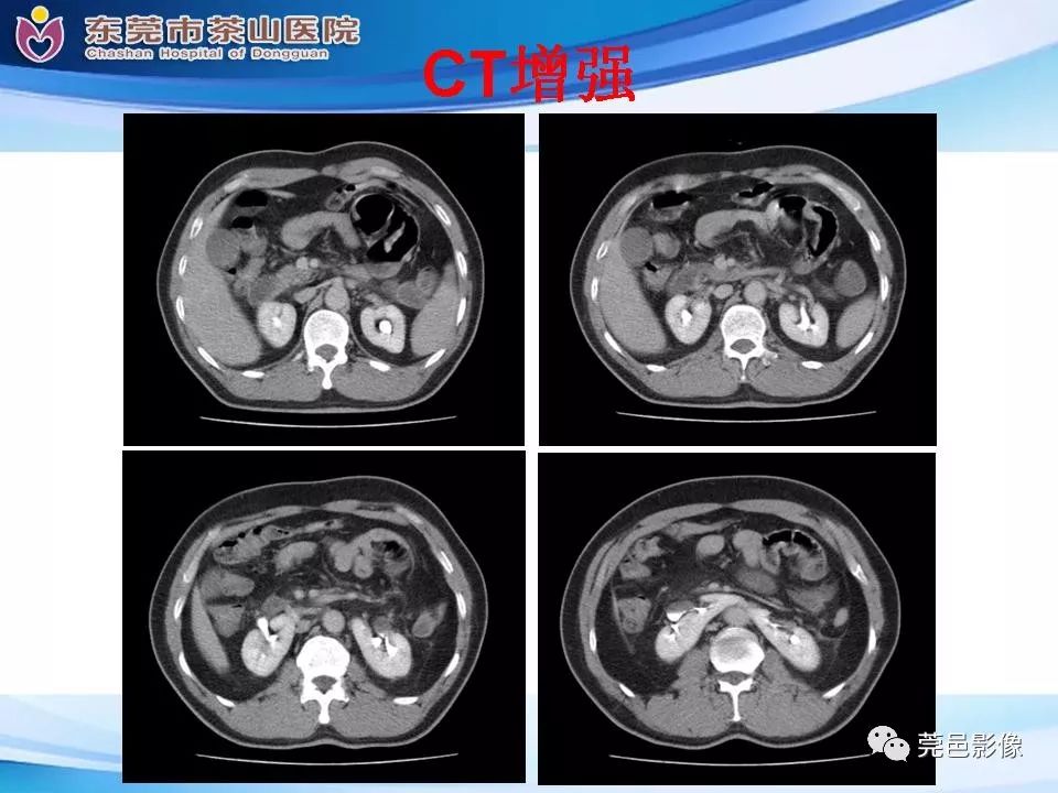 【PPT】腹茧症的影像诊断-14
