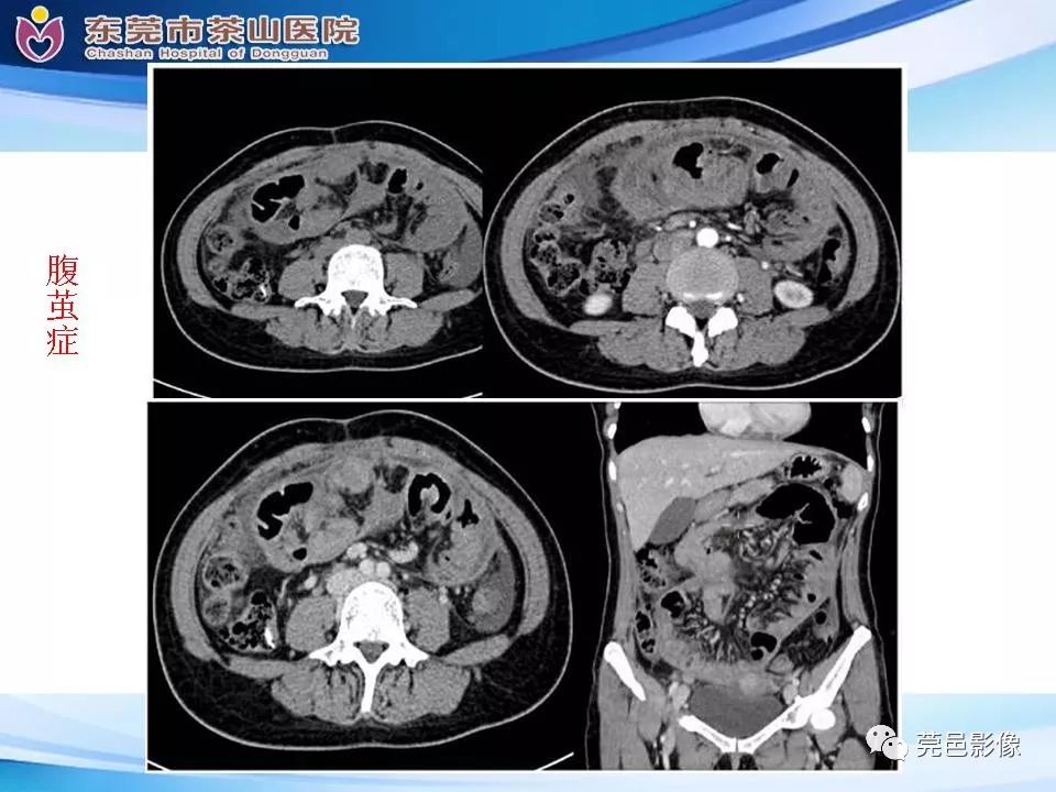 【PPT】腹茧症的影像诊断-34