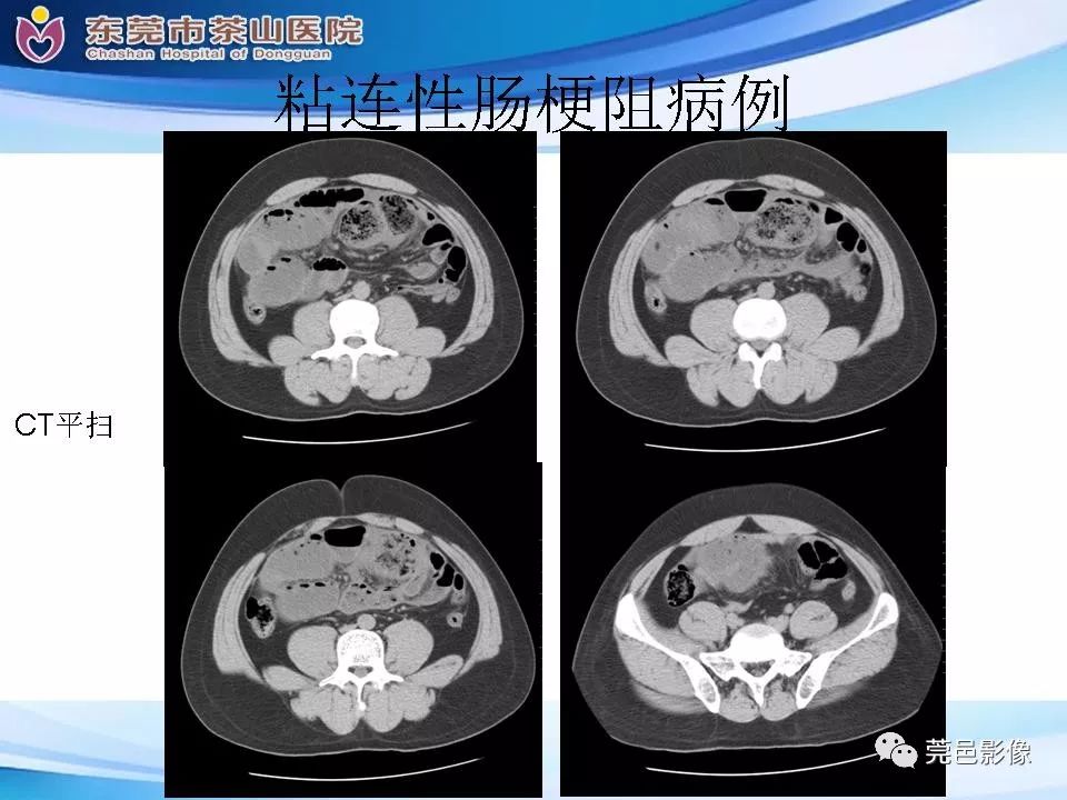 【PPT】腹茧症的影像诊断-51