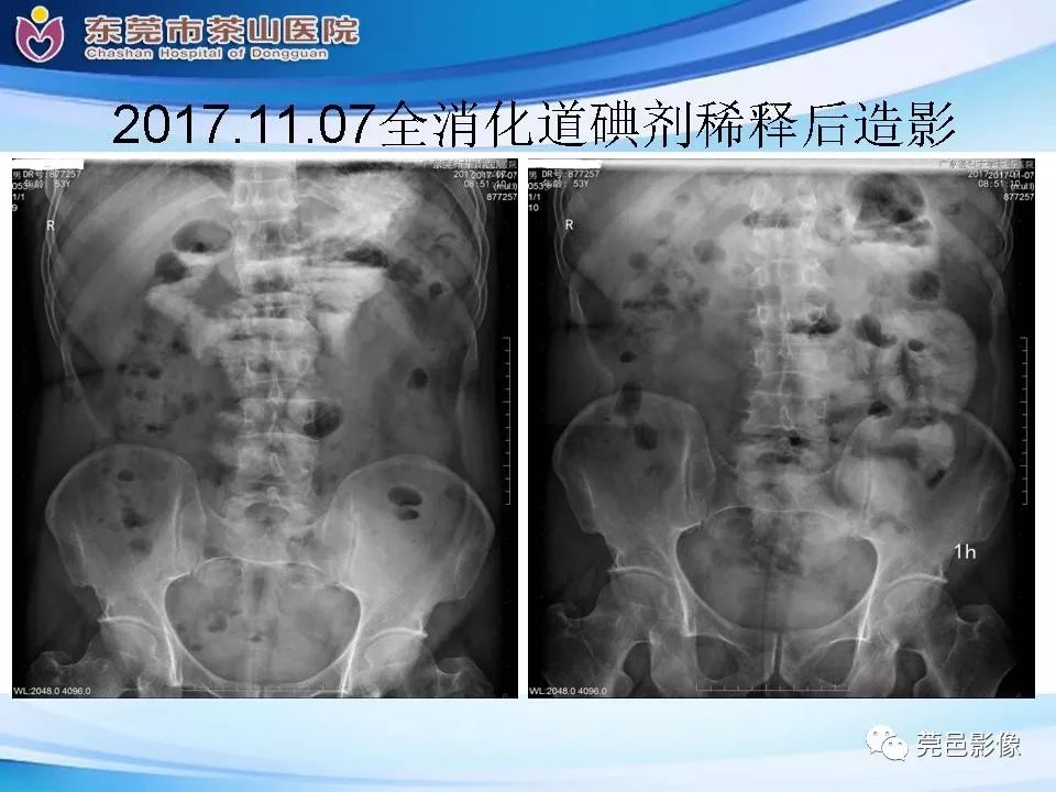 【PPT】腹茧症的影像诊断-7