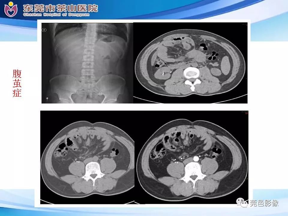 【PPT】腹茧症的影像诊断-32