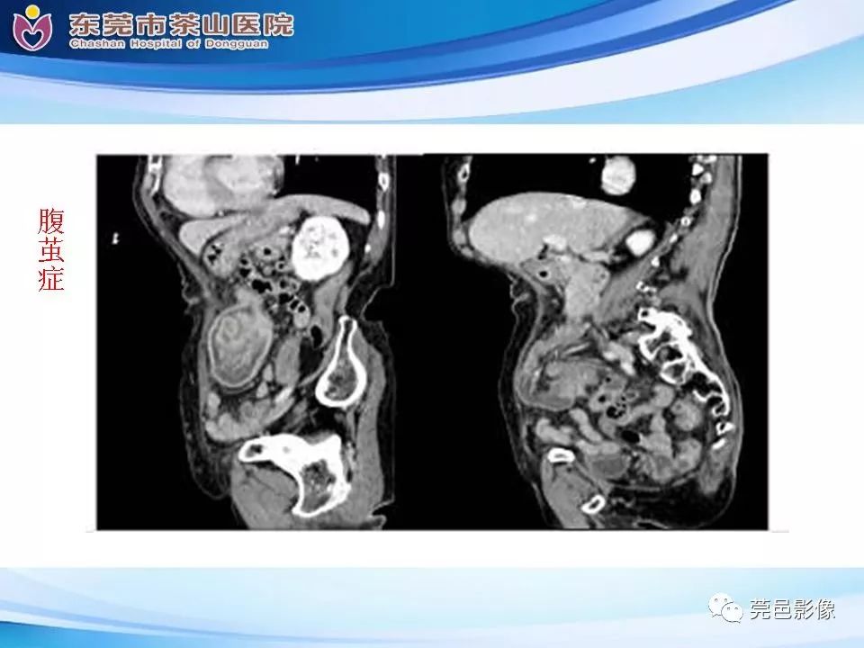 【PPT】腹茧症的影像诊断-36