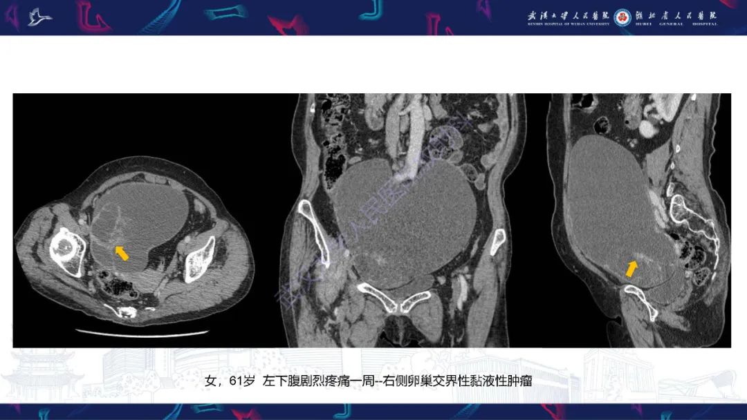 【PPT】盆腹腔巨大占位性病变影像诊断-27