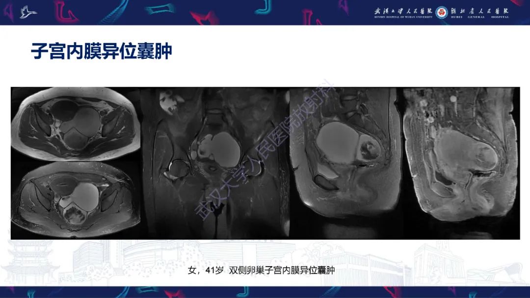 【PPT】盆腹腔巨大占位性病变影像诊断-14