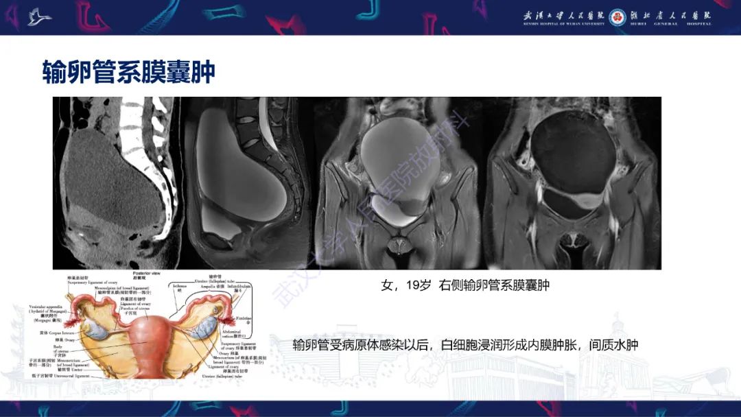 【PPT】盆腹腔巨大占位性病变影像诊断-12