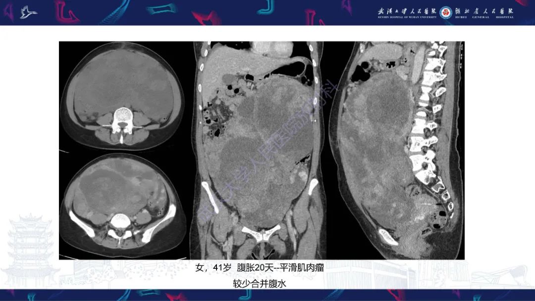 【PPT】盆腹腔巨大占位性病变影像诊断-45