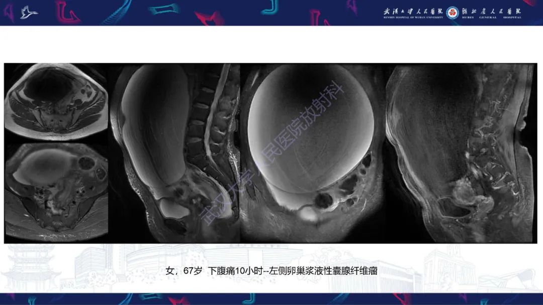 【PPT】盆腹腔巨大占位性病变影像诊断-39