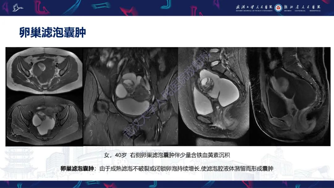 【PPT】盆腹腔巨大占位性病变影像诊断-13