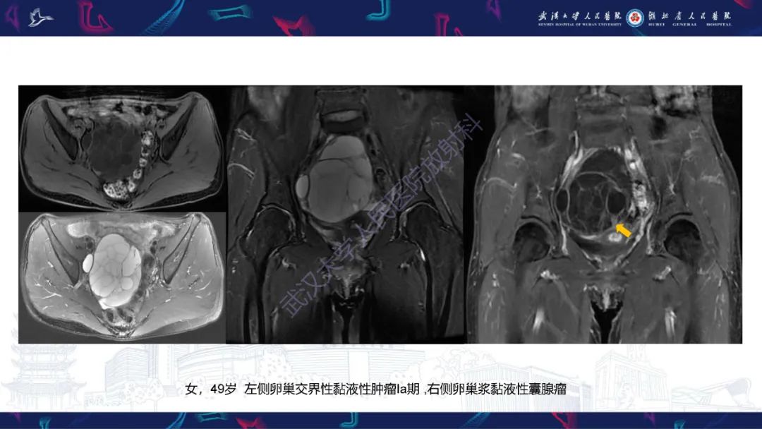 【PPT】盆腹腔巨大占位性病变影像诊断-32