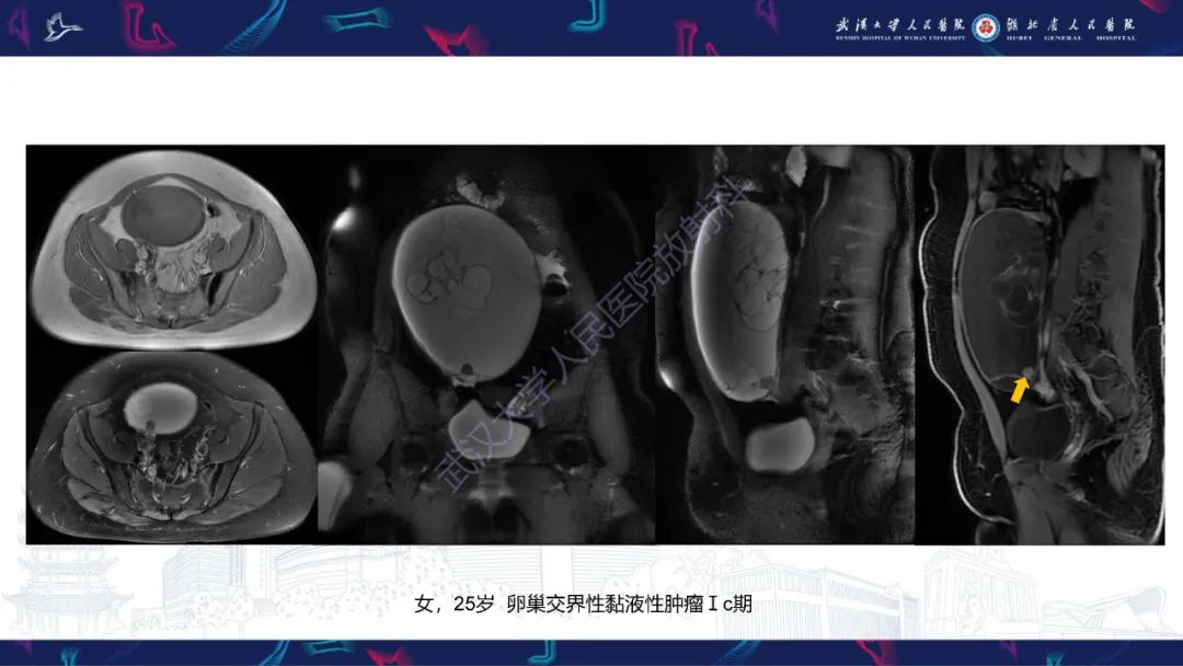 【PPT】盆腹腔巨大占位性病变影像诊断-25
