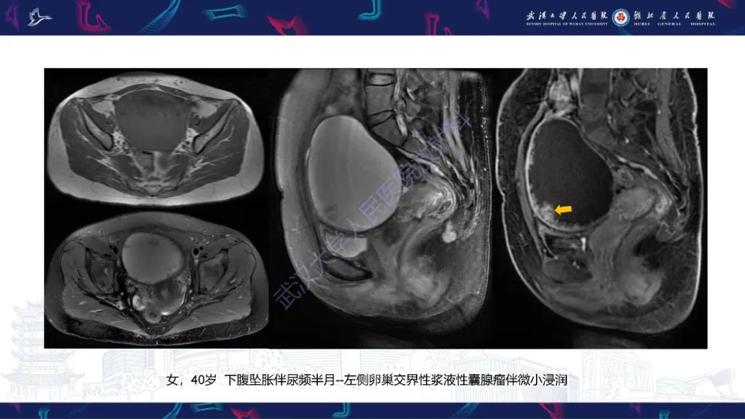 【PPT】盆腹腔巨大占位性病变影像诊断-28