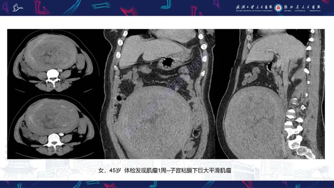 【PPT】盆腹腔巨大占位性病变影像诊断-48
