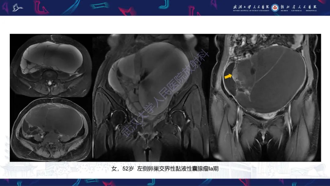 【PPT】盆腹腔巨大占位性病变影像诊断-30