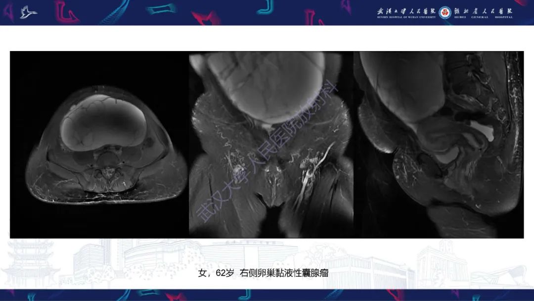 【PPT】盆腹腔巨大占位性病变影像诊断-18